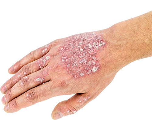 Psoriasis